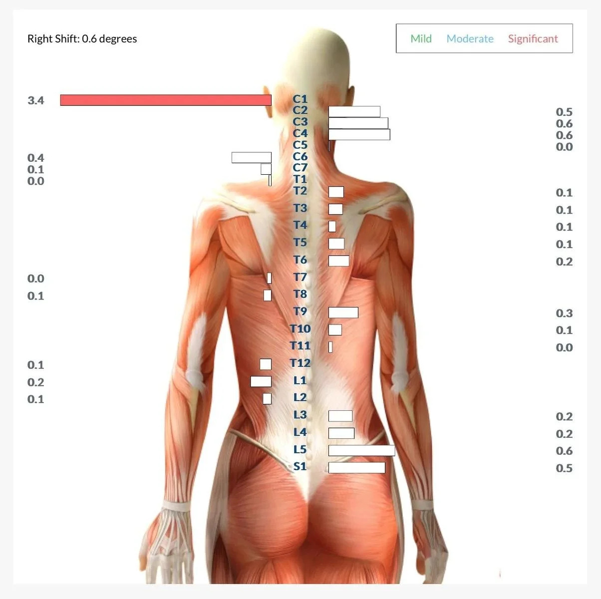 Muscle tension scan chart showing a right shift